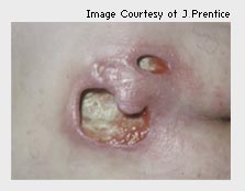 A photo of a Stage 4 PU