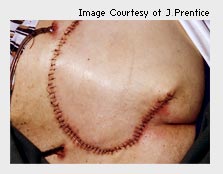 A photo of a patient who has undergone surgery to correct tissue deficit.