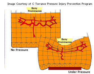 An illustrative representation of a person’s bony prominence sitting on top of a support surface with the text ‘No pressure’, and a second image of pressure, from the bony prominence, being absorbed into the support surface with the text ‘Under pressure’.