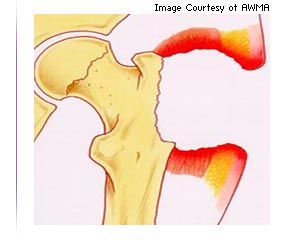 Illustration of full thickness skin loss with extensive destruction and damage.