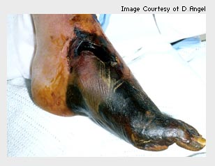 A photo of a foot with acute limb ischaemia.