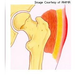 Illustration of pressure related alteration of intact skin