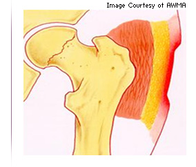 Illustration of partial thickness skin loss involving epidermis and/or dermis.