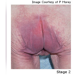 Photo of a pressure ulcer with the text Stage 1 underneath