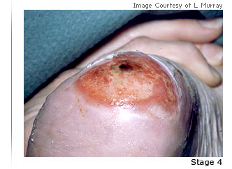 Photo of a pressure ulcer with the text Stage 4 underneath