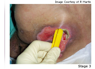 Photo of a pressure ulcer with the text Stage 4 underneath