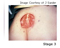 Photo of a pressure ulcer with the text Stage 3 underneath