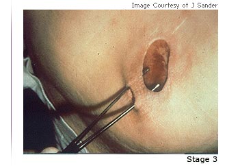 Photo of a pressure ulcer with the text Stage 2 underneath